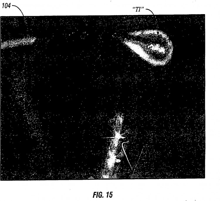 Ilustración 10 de la Galería de ilustraciones de SISTEMAS Y MÉTODO PARA PERFILAR TÉRMICAMENTE ELECTRODOS DE RADIOFRECUENCIA