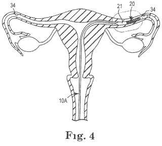 Dispositivo de oclusión y sistema para ocluir una cavidad corporal del aparato reproductor.