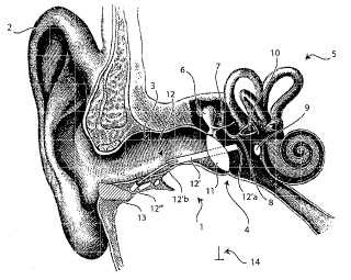 Audífono mejorado de acción directa en el oído medio y procedimiento de instalación relacionado.