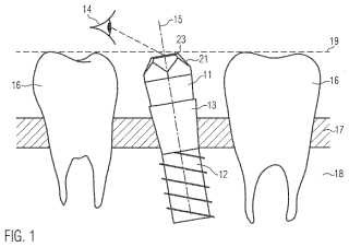 Determinación de la posición y la orientación de un implante dental.