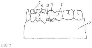 Estructura de puente como prótesis dental.