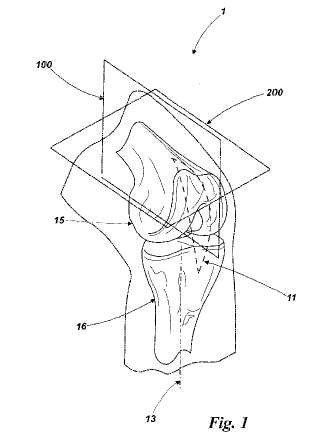Kit para una prótesis unicondilar lateral de rodilla.