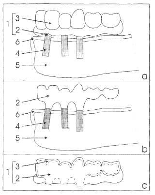 Procedimiento para el diseño y la producción de armazones basados en implantes para prótesis dentales complejas.
