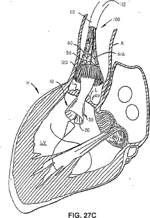 Ilustración 1 de la Galería de ilustraciones de Válvula cardiaca sustituible