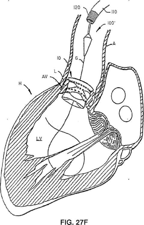 Ilustración 4 de la Galería de ilustraciones de Válvula cardiaca sustituible