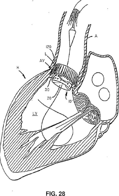 Ilustración 5 de la Galería de ilustraciones de Válvula cardiaca sustituible