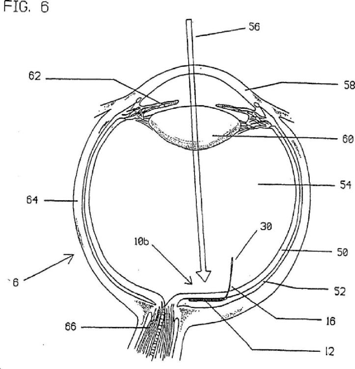 Ilustración 7 de la Galería de ilustraciones de Dispositivo de retina artificial