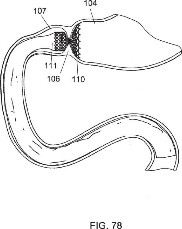 Ilustración 12 de la Galería de ilustraciones de Prótesis gastrointestinales modulares