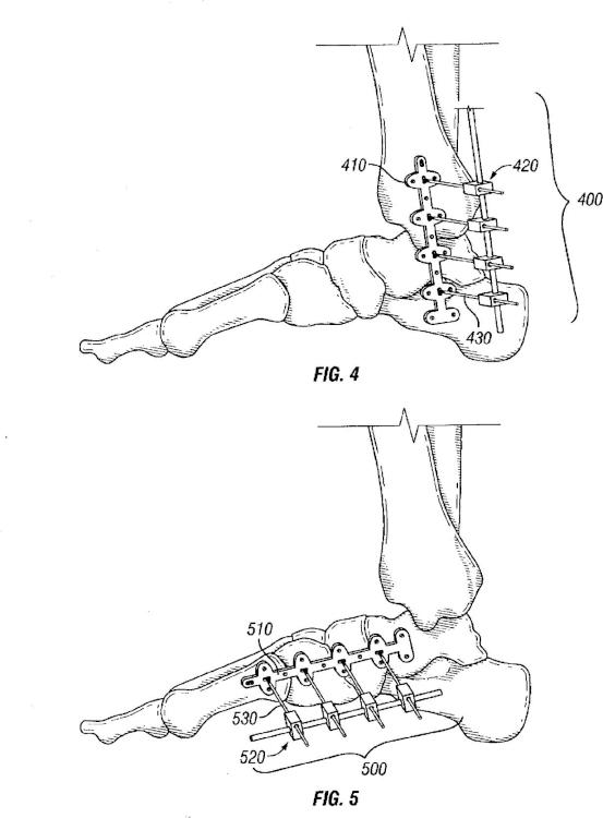 Ilustración 4 de la Galería de ilustraciones de Sistema de compresión y fijación de pie, tobillo y extremidad inferior