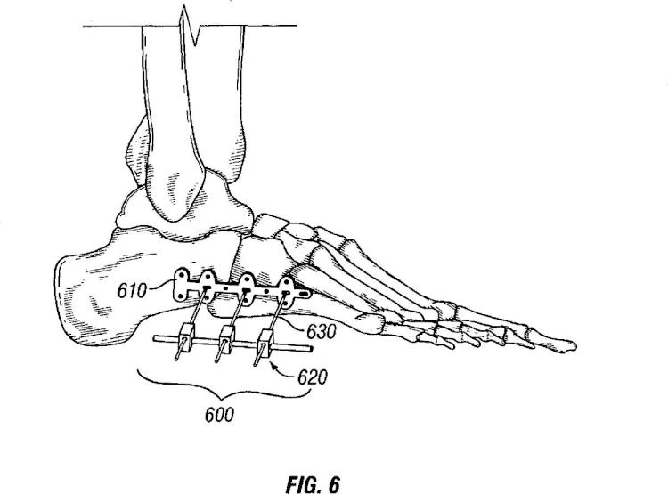 Ilustración 5 de la Galería de ilustraciones de Sistema de compresión y fijación de pie, tobillo y extremidad inferior