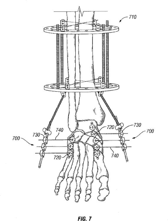 Ilustración 6 de la Galería de ilustraciones de Sistema de compresión y fijación de pie, tobillo y extremidad inferior