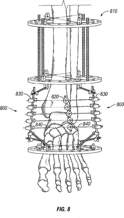 Ilustración 7 de la Galería de ilustraciones de Sistema de compresión y fijación de pie, tobillo y extremidad inferior