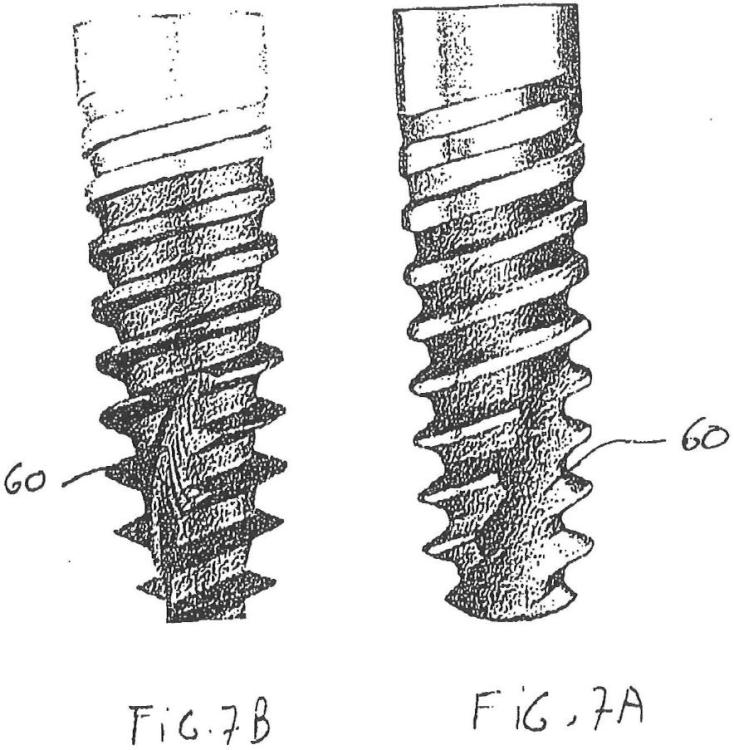 Ilustración 4 de la Galería de ilustraciones de Implante óseo de condensación que facilita la introducción