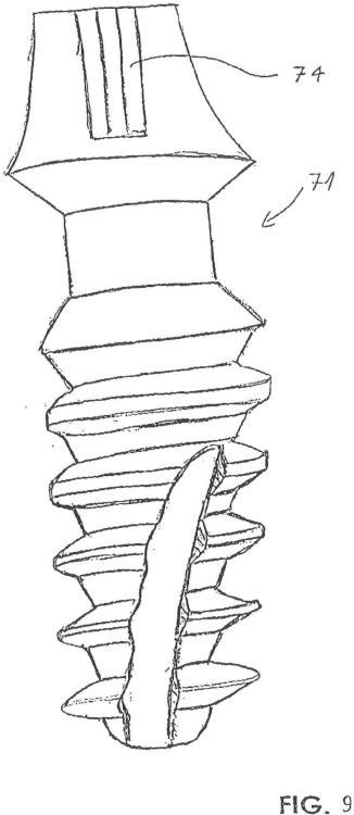 Ilustración 6 de la Galería de ilustraciones de Implante óseo de condensación que facilita la introducción
