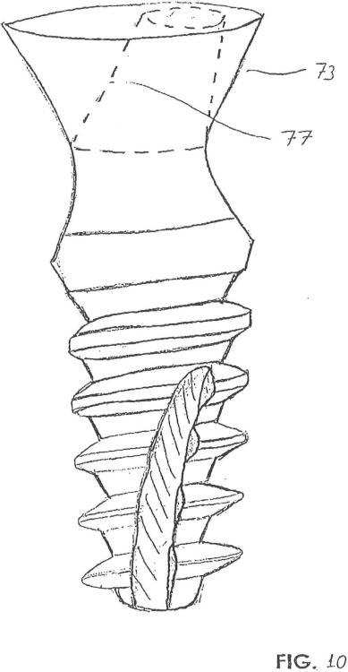 Ilustración 7 de la Galería de ilustraciones de Implante óseo de condensación que facilita la introducción