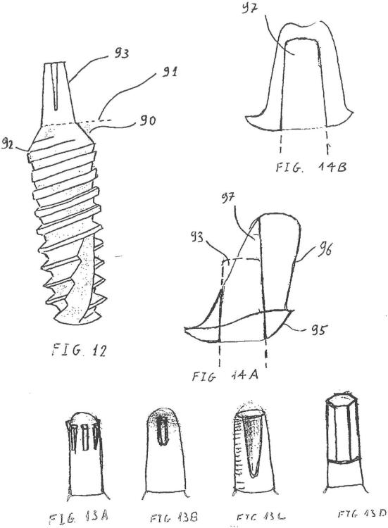Ilustración 9 de la Galería de ilustraciones de Implante óseo de condensación que facilita la introducción