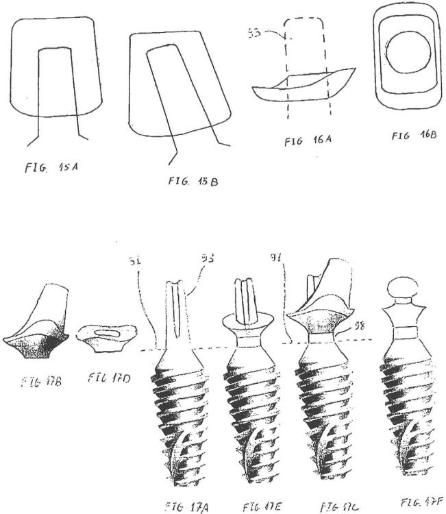 Ilustración 10 de la Galería de ilustraciones de Implante óseo de condensación que facilita la introducción