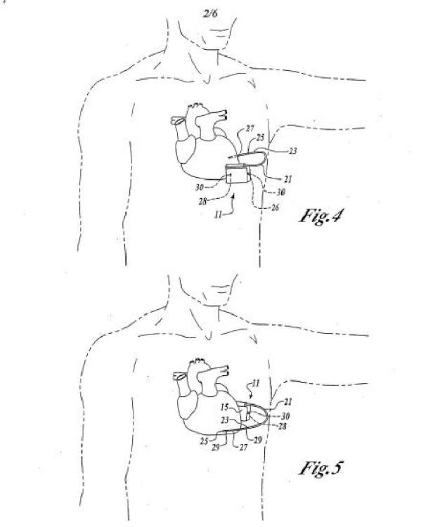 Ilustración 2 de la Galería de ilustraciones de Cardioversor-desfibrilador y marcapasos opcional implantables sólo subcutáneamente
