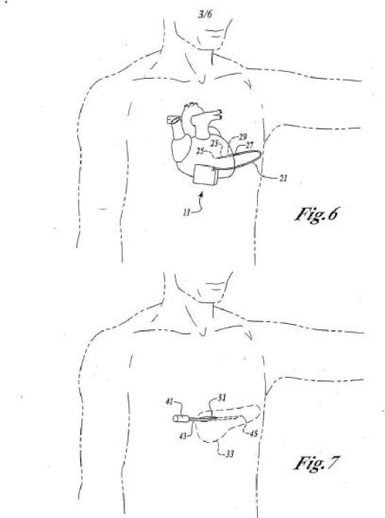 Ilustración 3 de la Galería de ilustraciones de Cardioversor-desfibrilador y marcapasos opcional implantables sólo subcutáneamente