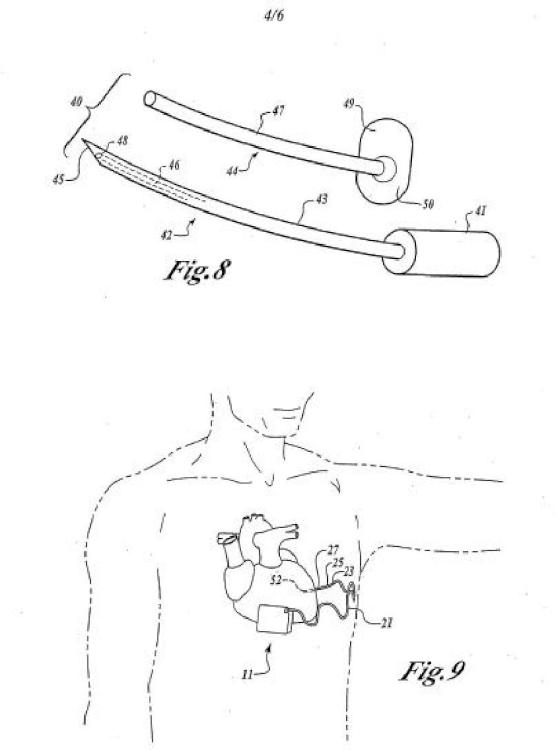Ilustración 4 de la Galería de ilustraciones de Cardioversor-desfibrilador y marcapasos opcional implantables sólo subcutáneamente