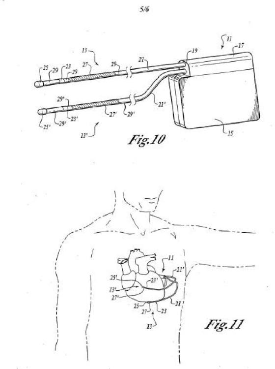 Ilustración 5 de la Galería de ilustraciones de Cardioversor-desfibrilador y marcapasos opcional implantables sólo subcutáneamente