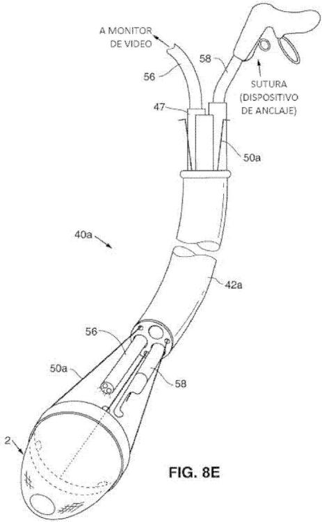 Ilustración 8 de la Galería de ilustraciones de Instrumentos de posicionamiento para implantar una bolsa de saciedad