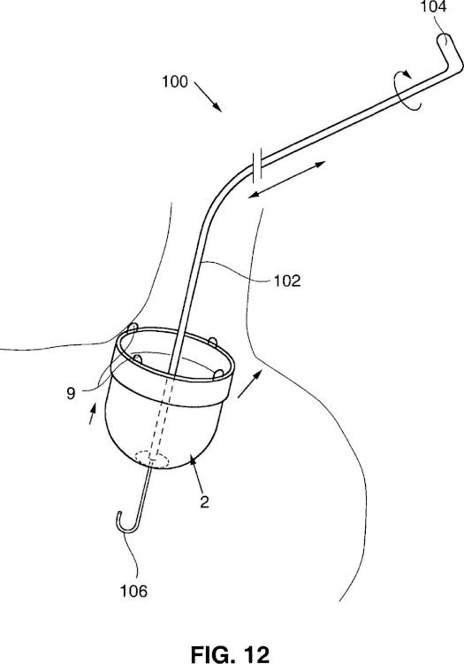 Ilustración 12 de la Galería de ilustraciones de Instrumentos de posicionamiento para implantar una bolsa de saciedad