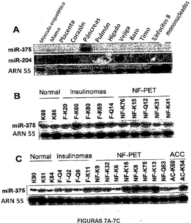 Ilustración 7 de la Galería de ilustraciones de Anomalías de la expresión de microARN en tumores pancreáticos endocrinos y acinares