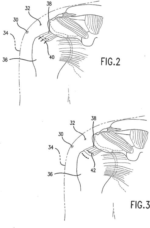 Ilustración 2 de la Galería de ilustraciones de Aparato artroscrópico para la unión de tejido al hueso