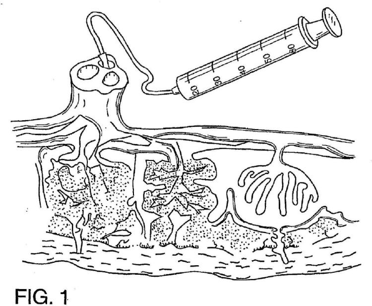 Ilustración 1 de la Galería de ilustraciones de Método para recolectar células troncales placentarias