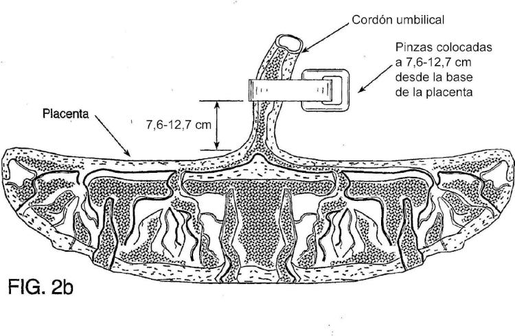 Ilustración 3 de la Galería de ilustraciones de Método para recolectar células troncales placentarias
