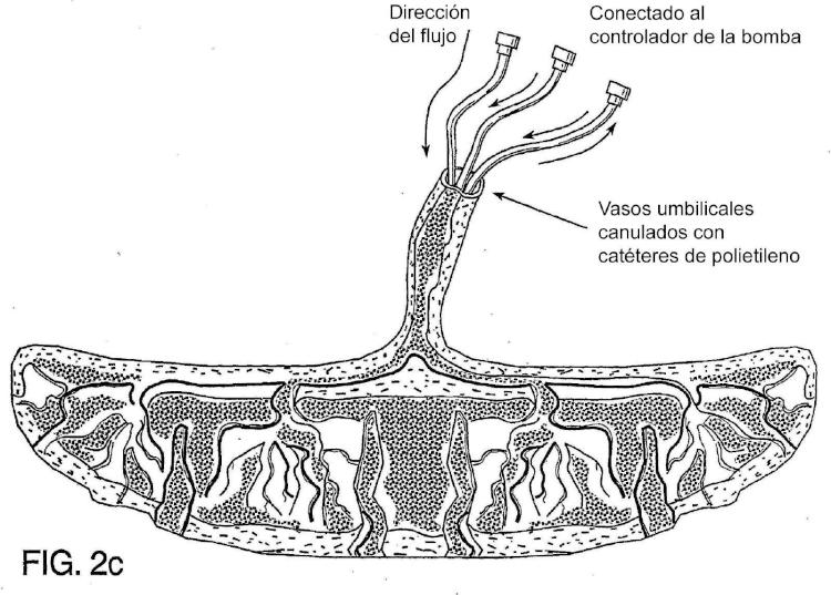 Ilustración 4 de la Galería de ilustraciones de Método para recolectar células troncales placentarias