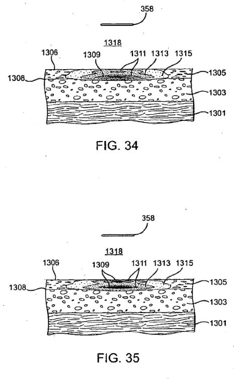 Ilustración 2 de la Galería de ilustraciones de Sistemas para crear un efecto sobre un tejido especificado usando energía de microondas