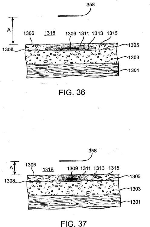 Ilustración 3 de la Galería de ilustraciones de Sistemas para crear un efecto sobre un tejido especificado usando energía de microondas