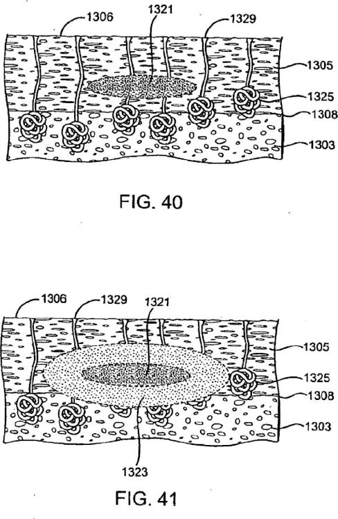 Ilustración 5 de la Galería de ilustraciones de Sistemas para crear un efecto sobre un tejido especificado usando energía de microondas