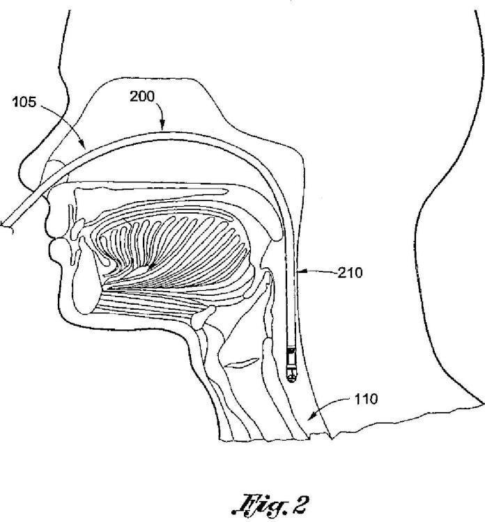 Ilustración 3 de la Galería de ilustraciones de Sonda esofágica flexible de monitorización por Doppler