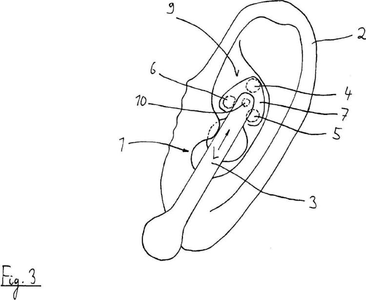 Dispositivo para aplicar un impulso de estimulación eléctrica transcutánea sobre la superficie de una sección de la oreja humana.