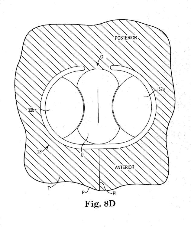 Ilustración 11 de la Galería de ilustraciones de Sistema de esfínter urinario artificial que tiene un manguito con un balón o globo fijado a un bastidor