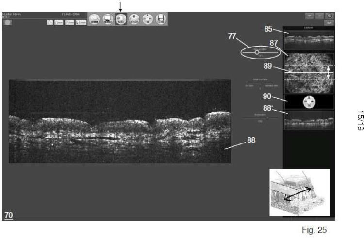 Ilustración 8 de la Galería de ilustraciones de Sistema y procedimiento para tomografía de coherencia óptica