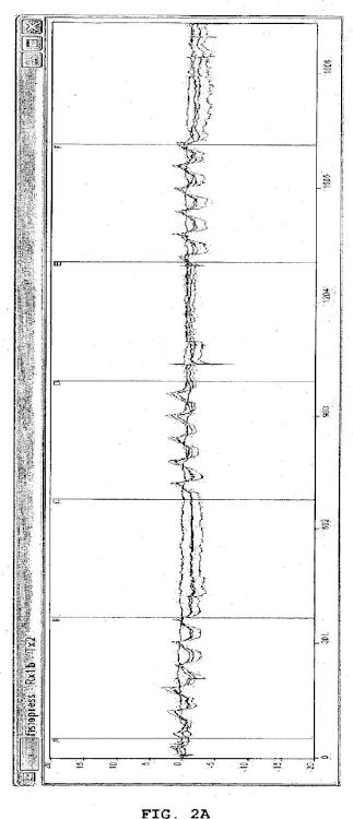 Ilustración 2 de la Galería de ilustraciones de Dispositivo para el tratamiento neumático de una extremidad inferior con problemas de arteriopatía periférica