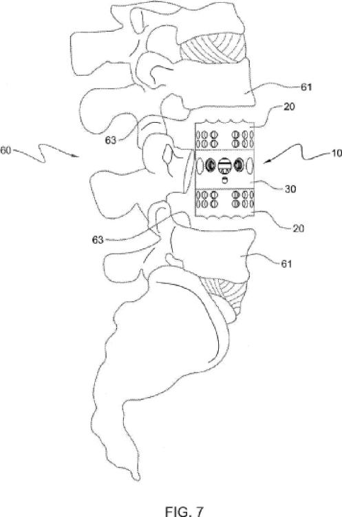 Ilustración 5 de la Galería de ilustraciones de Miembro de placa de soporte de un dispositivo de sustitución del cuerpo vertebral, y método de montaje asociado
