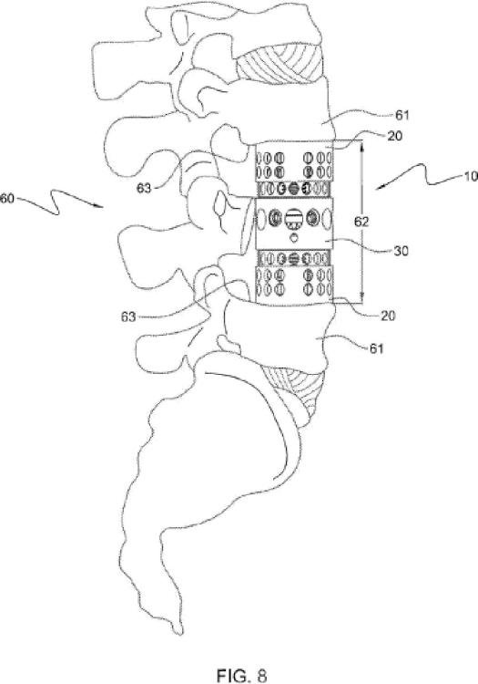 Ilustración 6 de la Galería de ilustraciones de Miembro de placa de soporte de un dispositivo de sustitución del cuerpo vertebral, y método de montaje asociado