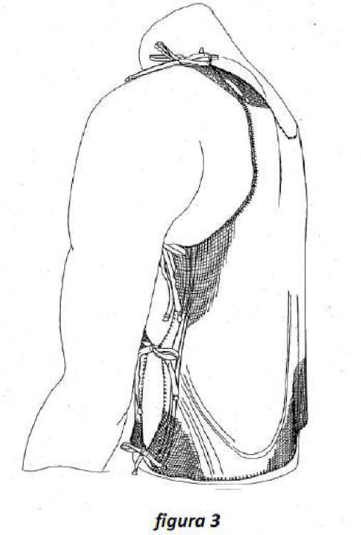 Ilustración 3 de la Galería de ilustraciones de Prenda celulósica carboximetilada como apósito para heridas