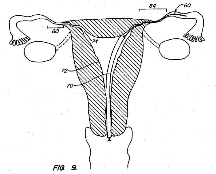 Ilustración 4 de la Galería de ilustraciones de Dispositivos contraconceptivos transcervicales de oclusión de las trompas de Falopio
