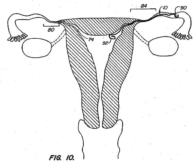 Ilustración 5 de la Galería de ilustraciones de Dispositivos contraconceptivos transcervicales de oclusión de las trompas de Falopio