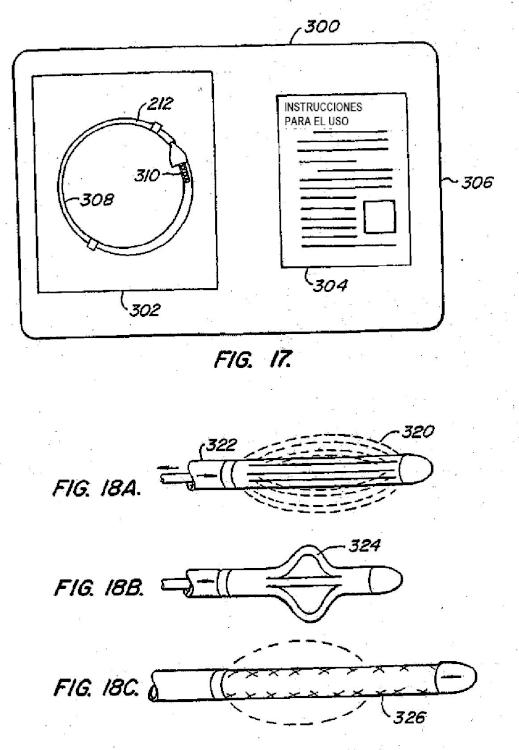 Ilustración 13 de la Galería de ilustraciones de Dispositivos contraconceptivos transcervicales de oclusión de las trompas de Falopio
