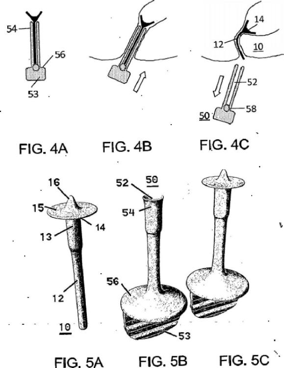 Ilustración 3 de la Galería de ilustraciones de Dispositivo para incontinencia fecal