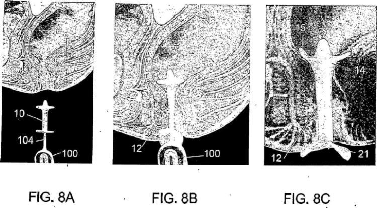 Ilustración 7 de la Galería de ilustraciones de Dispositivo para incontinencia fecal