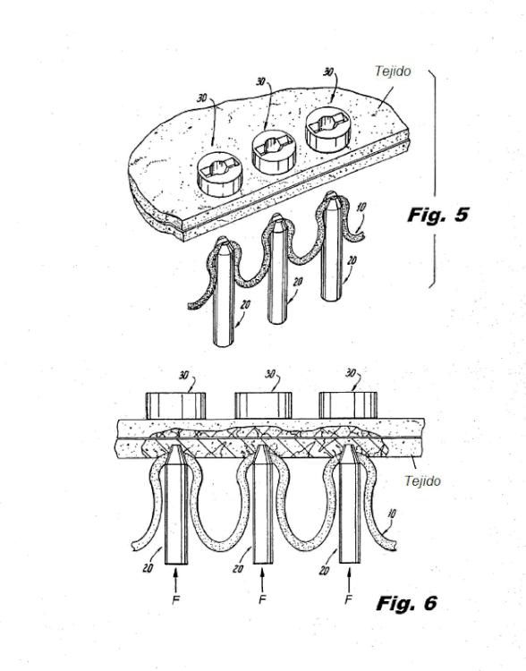 Ilustración 2 de la Galería de ilustraciones de Conjunto de sutura y retenedor