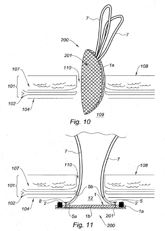 Ilustración 7 de la Galería de ilustraciones de Prótesis para hernia umbilical